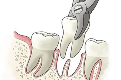 Tooth Extraction minor surgery