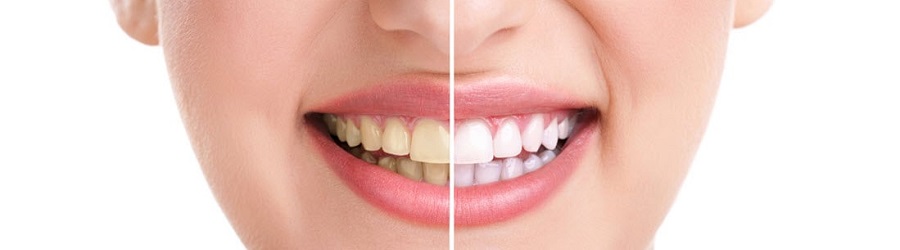 teeth whitening oakwood